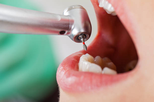Best Emergency Wisdom Teeth Removal in Birmingham, AL